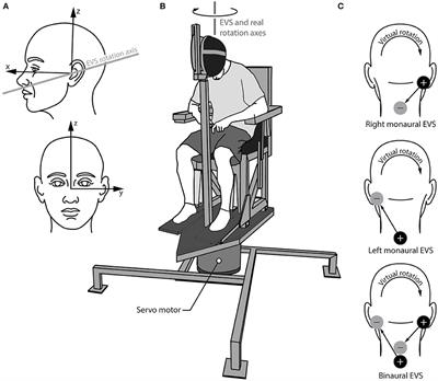 Asymmetric Unilateral Vestibular Perception in Adolescents With Idiopathic Scoliosis